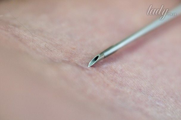 В Україні скасовують пробу Манту: з квітня нові методи виявлення туберкульозу